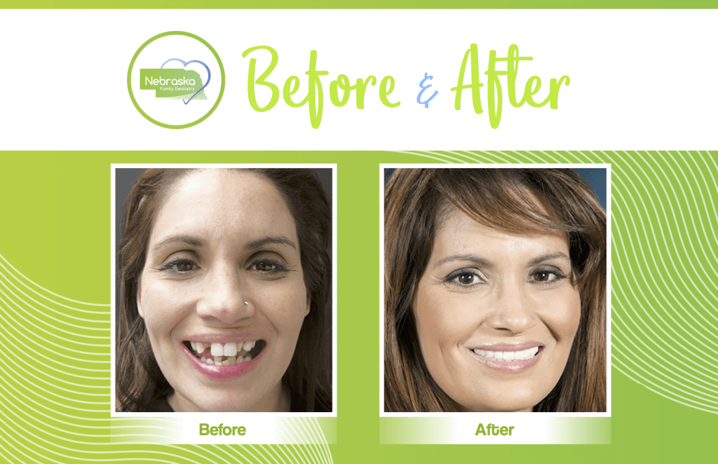 Cosmetic Dentist In Near South Lincoln Nebraska Neb NE