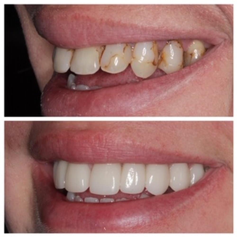 Cosmetic Dentist In Point Richmond California Calif CA