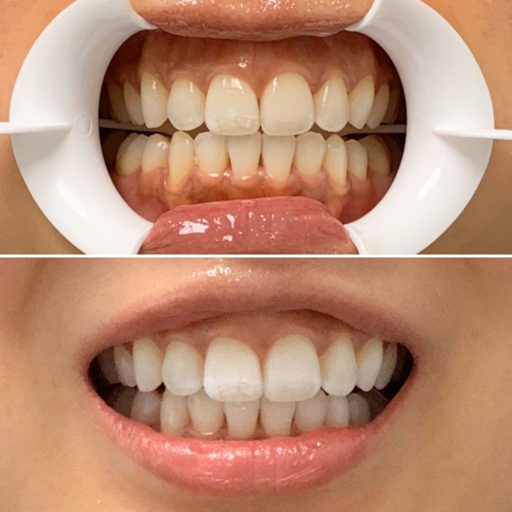 Cosmetic Dentist In Saddle Rock Aurora Colorado Colo CO