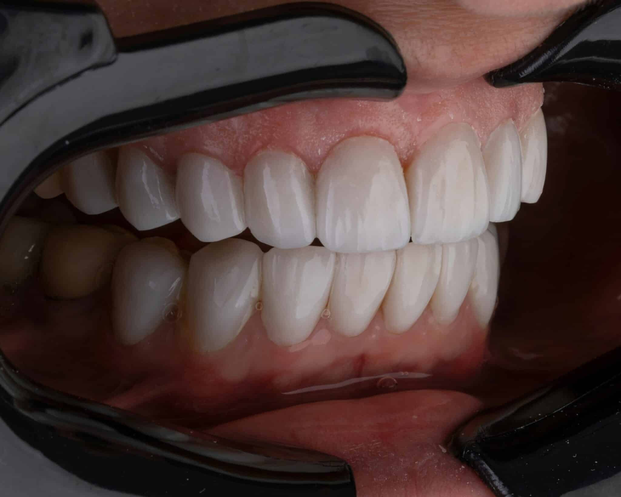 Cosmetic Dentist In Sunset Pueblo Colorado Colo CO Cosmetic Dentist In Sunset Pueblo Colorado Colo CO