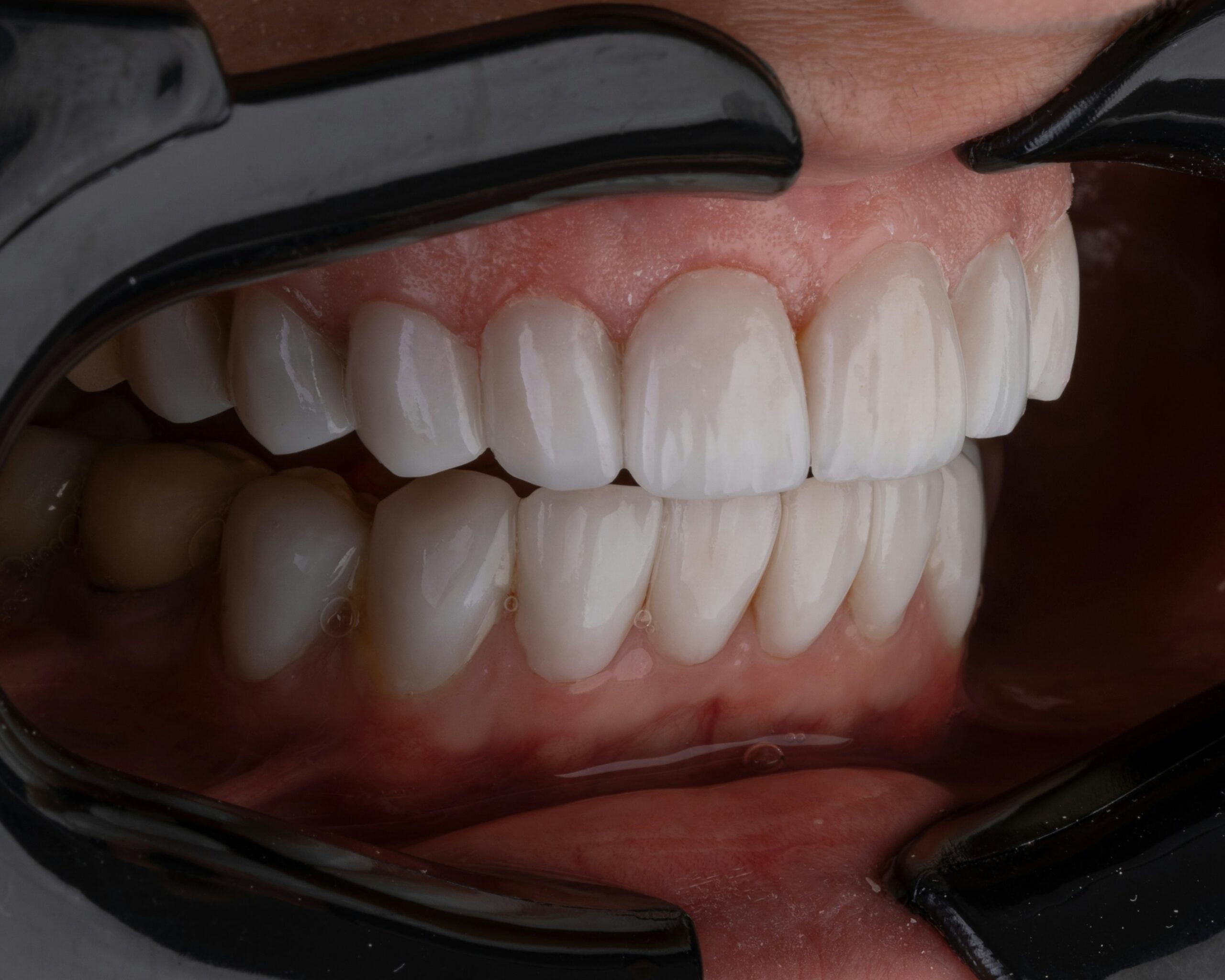 Cosmetic Dentist In Upper Arlington Columbus Ohio OH