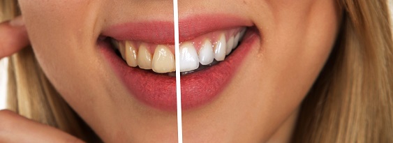 Cosmetic Dentist In Vilas Neighborhood Madison Wisconsin Wis WI