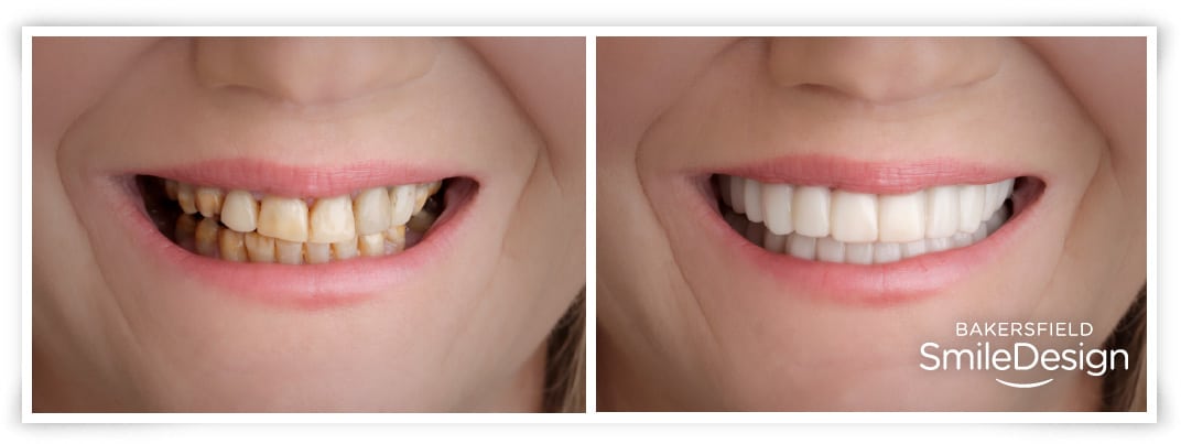 Cosmetic Dentist In Westchester Bakersfield California Calif CA