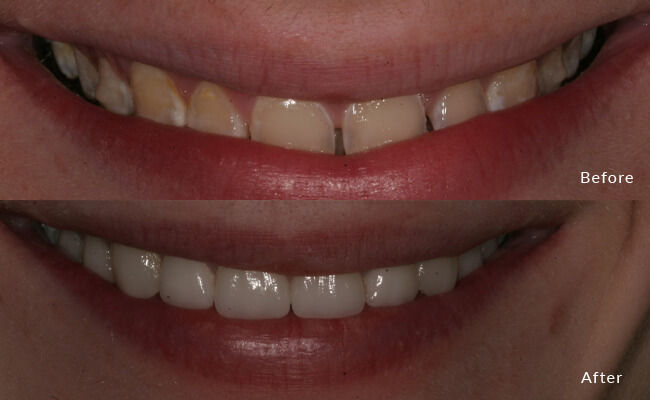 Cosmetic Dentist In Willy Street Williamson Marquette Madison Wisconsin Wis WI