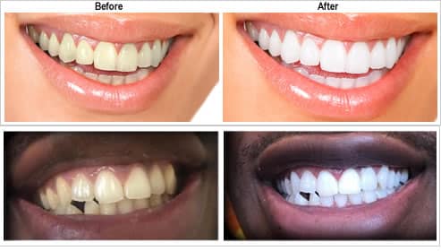 Cosmetic Dentistry Fort Collins Co 1 Cosmetic Dentistry Fort Collins Co