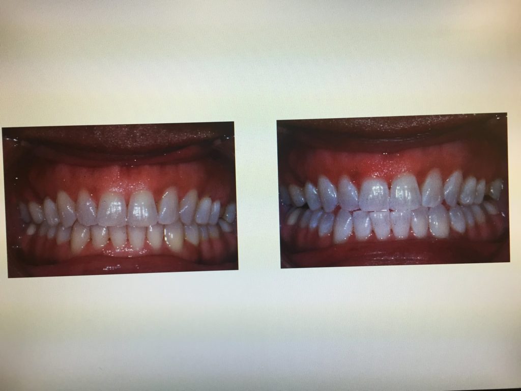 Is Teeth Bleaching Safe Is Teeth Bleaching Safe