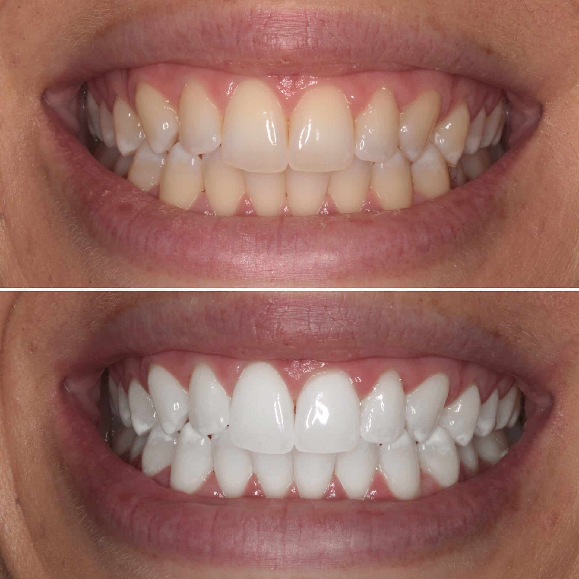 Is Teeth Bleaching Safe Is Teeth Bleaching Safe