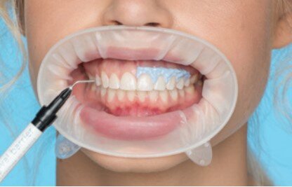 What Are the Long-term Effects of Repeated Dental Bleaching? 1 What Are the Long-term Effects of Repeated Dental Bleaching?