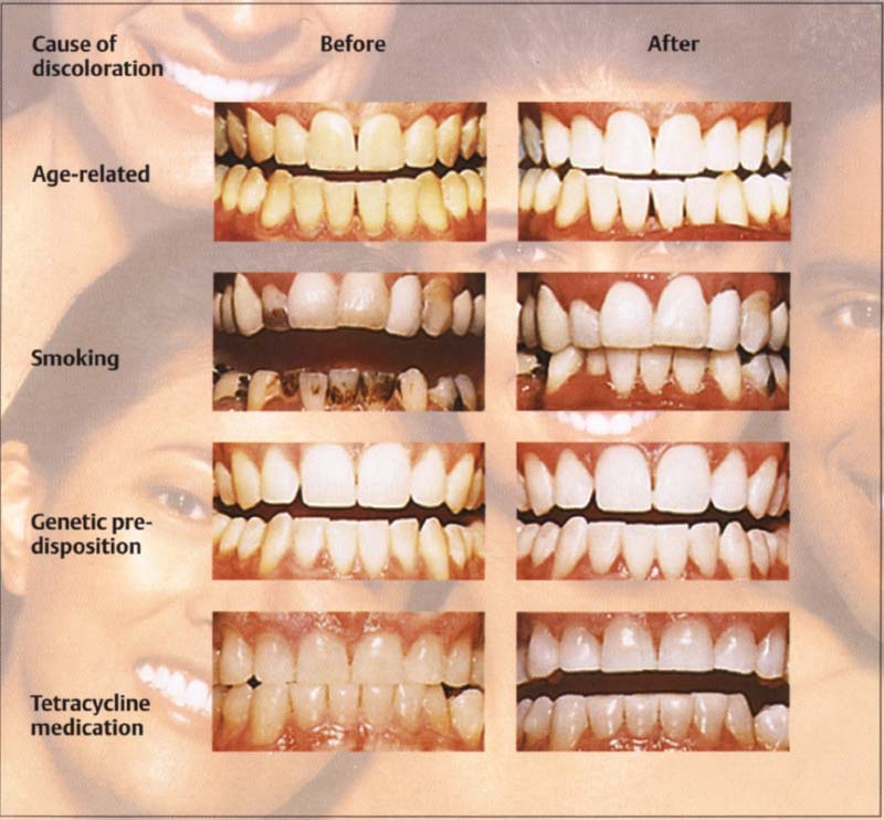 Process Of Bleaching Teeth Process Of Bleaching Teeth