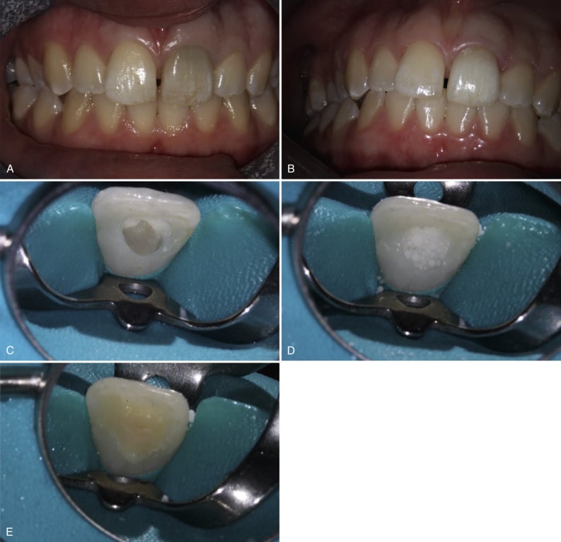 Process Of Bleaching Teeth Process Of Bleaching Teeth