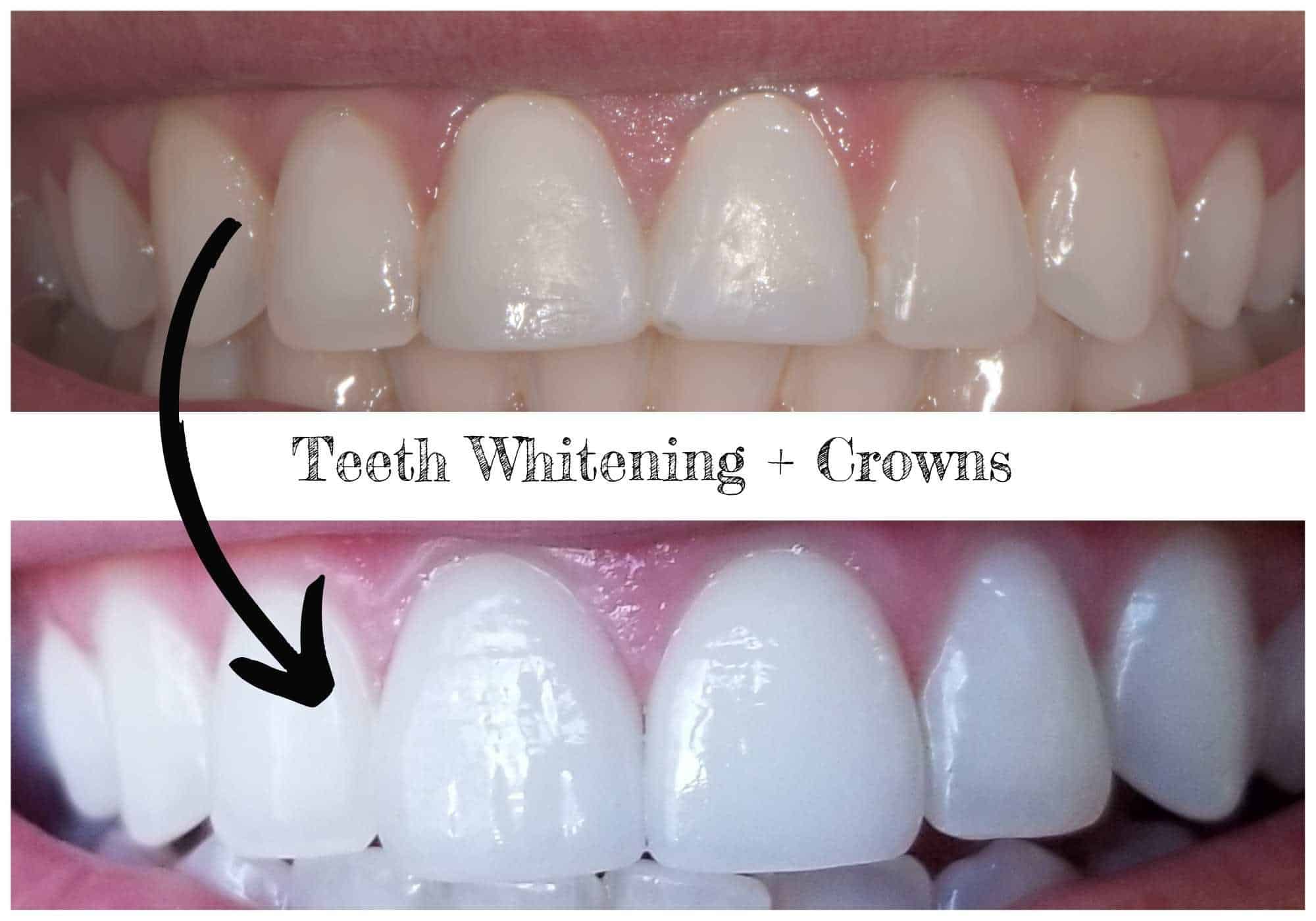 What Teeth Whitening Works Best What Teeth Whitening Works Best