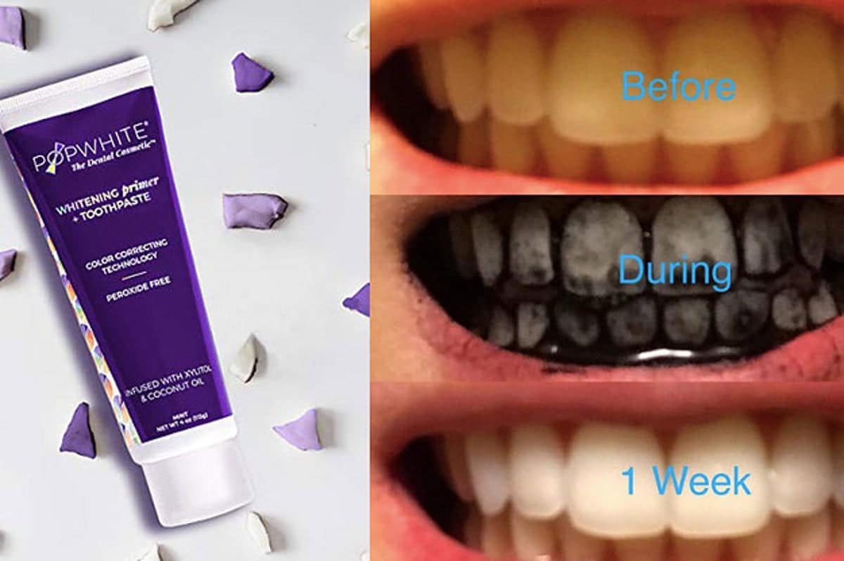 What Teeth Whitening Works Best What Teeth Whitening Works Best
