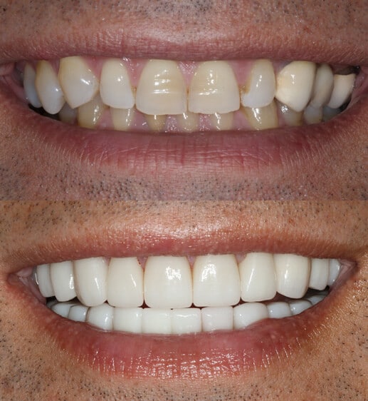 Cosmetic Dentist In Harbor Beach Lauderdale Florida Fla FL