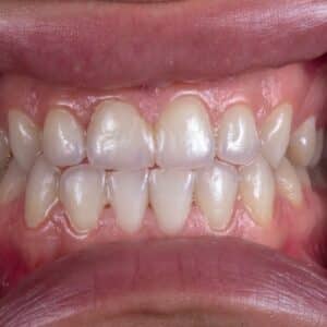 Photo Teeth whitening