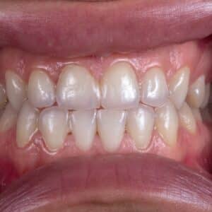 Photo Teeth whitening