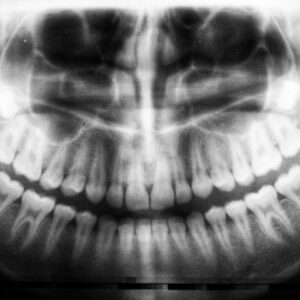 Photo Dental composite