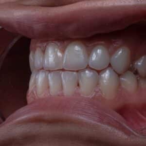 Photo Teeth whitening