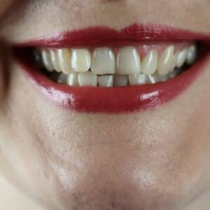 Photo Teeth whitening