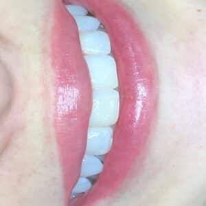 Photo "Can I Get Cosmetic Dentistry on the NHS"