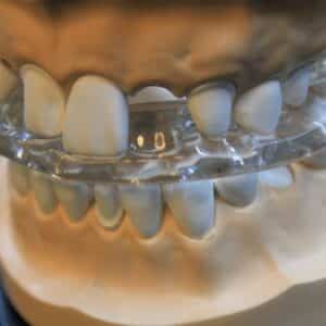 Photo Cosmetic Bonding Teeth Before and After