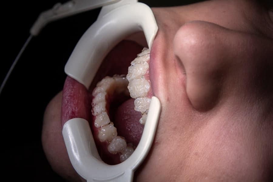 Gum Surgery Killearn Estates 1 Gum Surgery Killearn Estates