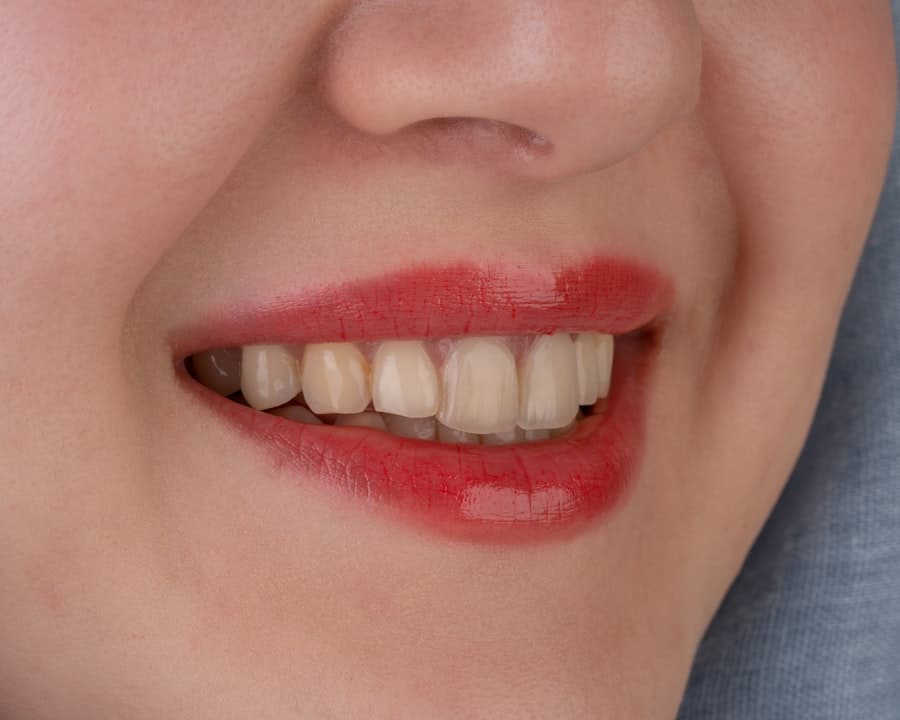 Veneers in North Richland Hills 1 Veneers
