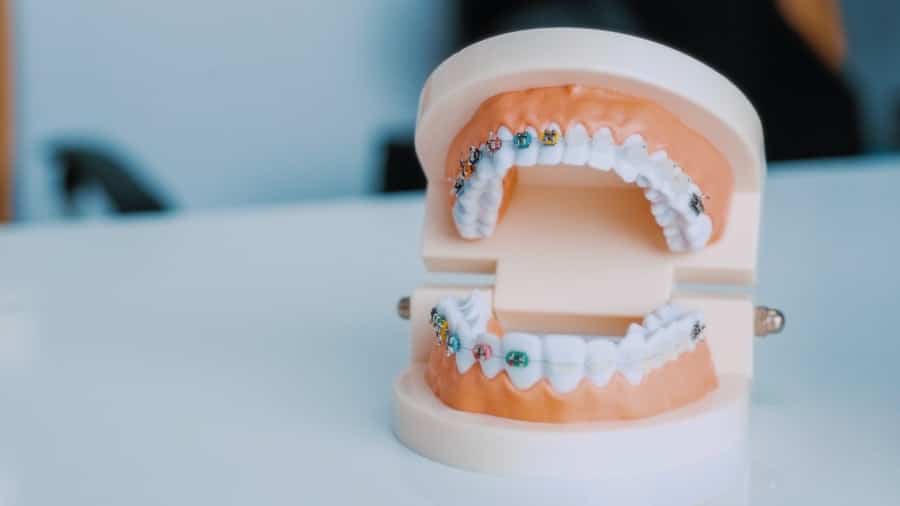 Bonded Dental Bridges Buchanan 1 Dental Bridges