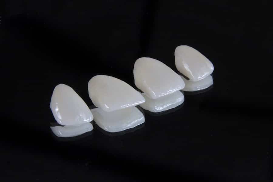 Veneers in North Richland Hills 2 Photo Veneers