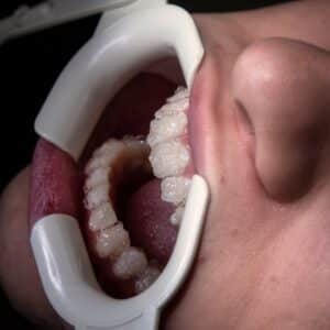Photo Teeth Fix