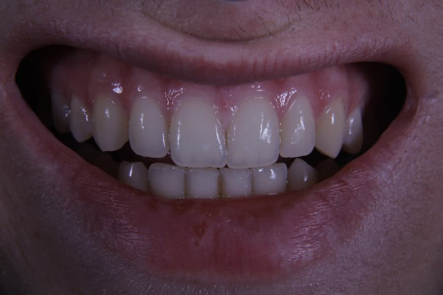 Whiten Your Teeth