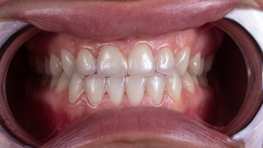 Whitening for Sensitive Teeth