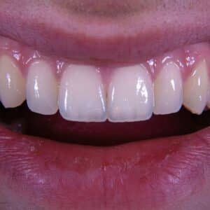 Photo Whitening for Sensitive Teeth