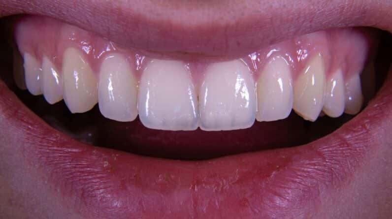 Photo Whitening for Sensitive Teeth