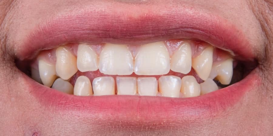 Photo Teeth Whitening Cost